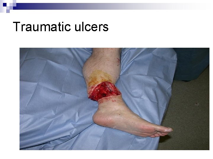 Traumatic ulcers 
