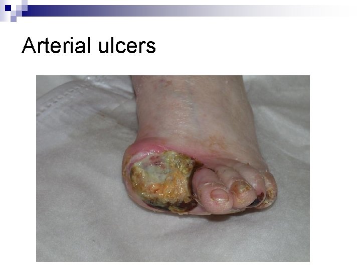 Arterial ulcers Arterial ulcers