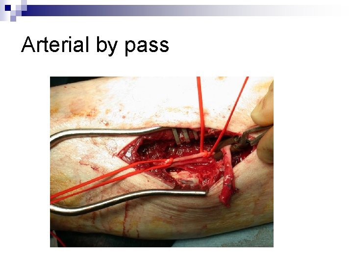 Arterial by pass 