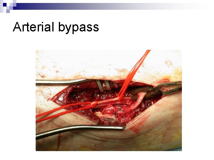 Arterial bypass 