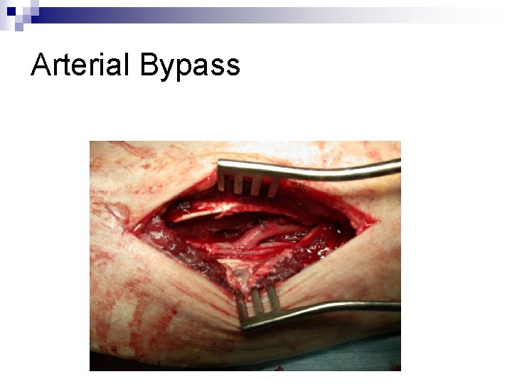 Arterial Bypass 