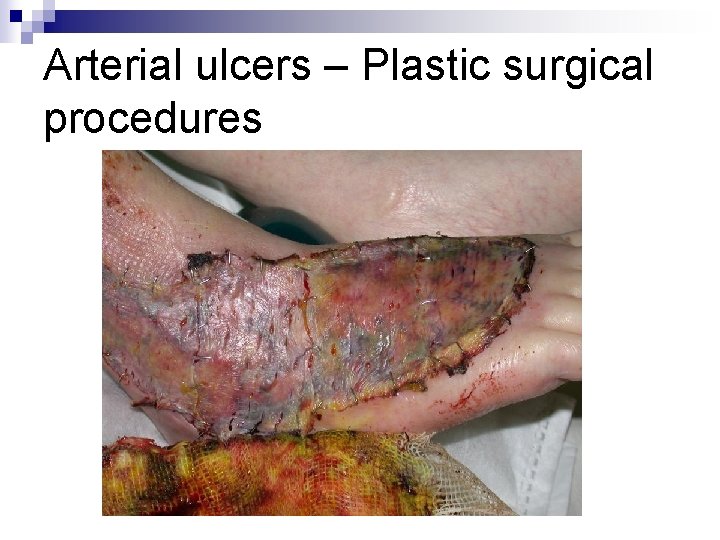 Arterial ulcers – Plastic surgical procedures 