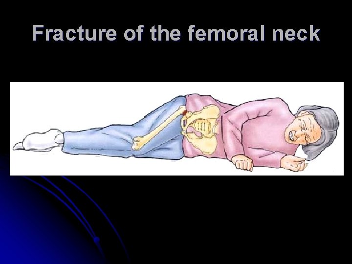 Fracture of the femoral neck Fracture of the femoral neck