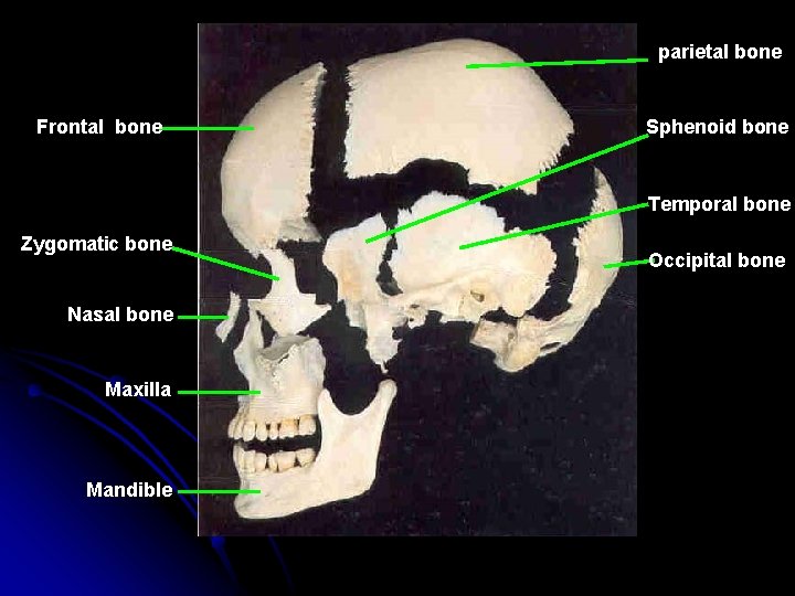parietal bone Frontal bone Sphenoid bone Temporal bone Zygomatic bone Nasal bone Maxilla Mandible parietal bone Frontal bone Sphenoid bone Temporal bone Zygomatic bone Nasal bone Maxilla Mandible