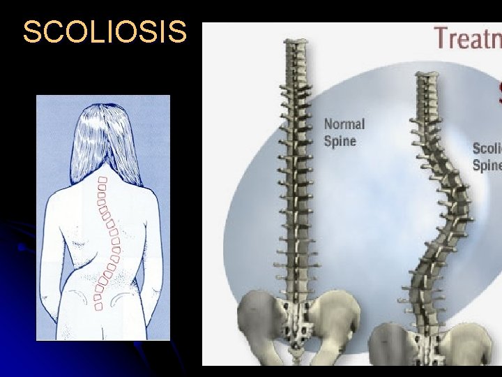 SCOLIOSIS SCOLIOSIS