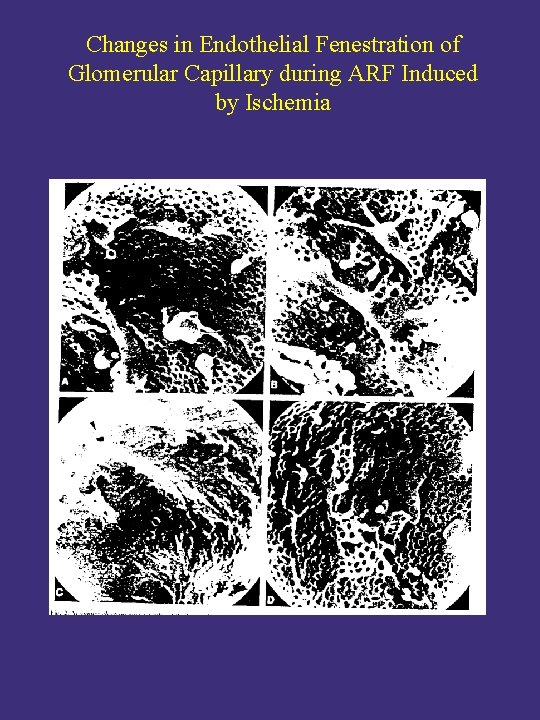 Changes in Endothelial Fenestration of Glomerular Capillary during ARF Induced by Ischemia Changes in Endothelial Fenestration of Glomerular Capillary during ARF Induced by Ischemia