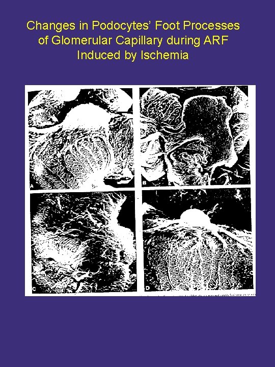 Changes in Podocytes’ Foot Processes of Glomerular Capillary during ARF Induced by Ischemia 