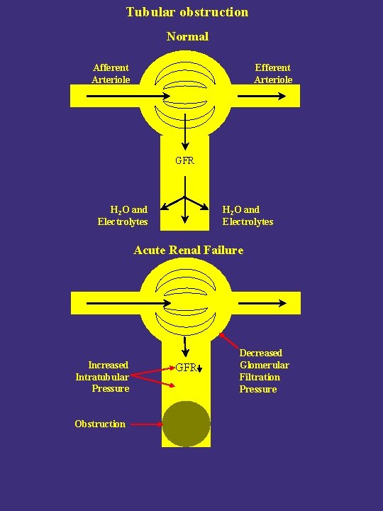 Tubular obstruction Normal Afferent Arteriole Efferent Arteriole GFR H 2 O and Electrolytes Acute