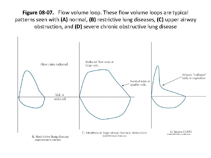 Figure 08 -07. Flow volume loop. These flow volume loops are typical patterns seen