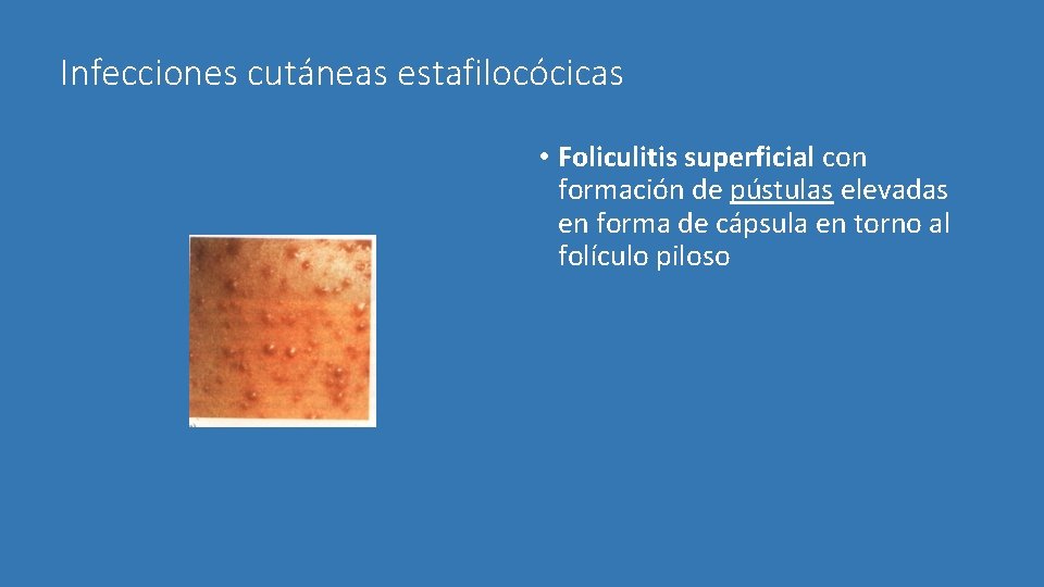 Infecciones cutáneas estafilocócicas • Foliculitis superficial con formación de pústulas elevadas en forma de