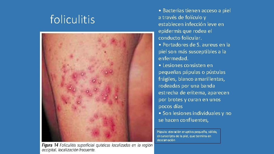 foliculitis • Bacterias tienen acceso a piel a través de folículo y establecen infección