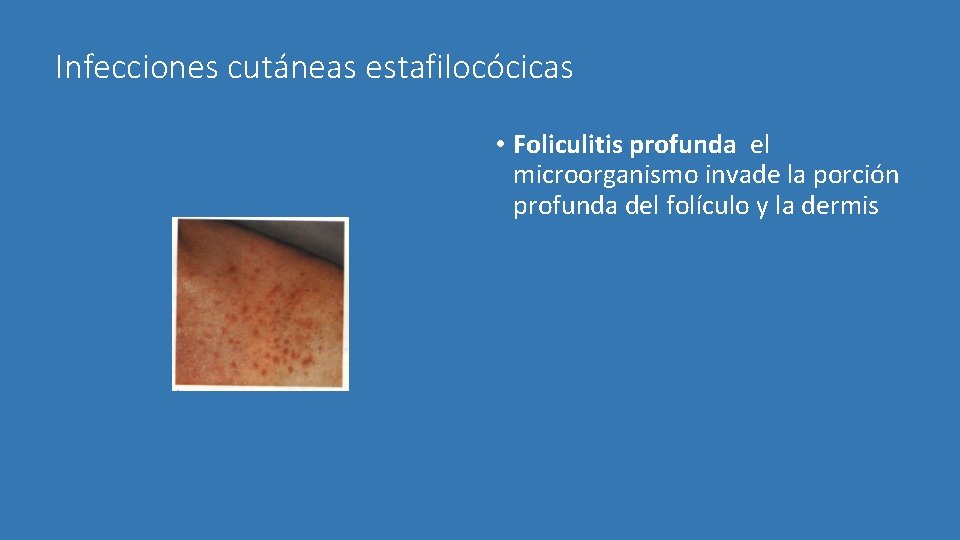 Infecciones cutáneas estafilocócicas • Foliculitis profunda el microorganismo invade la porción profunda del folículo