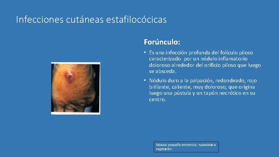 Infecciones cutáneas estafilocócicas Forúnculo: • Es una infección profunda del folículo piloso caracterizado por