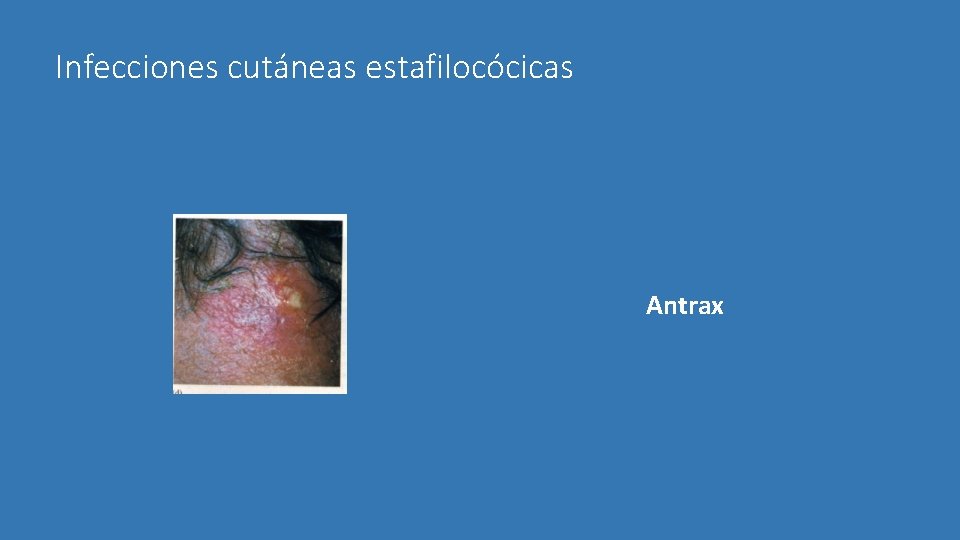 Infecciones cutáneas estafilocócicas Antrax 