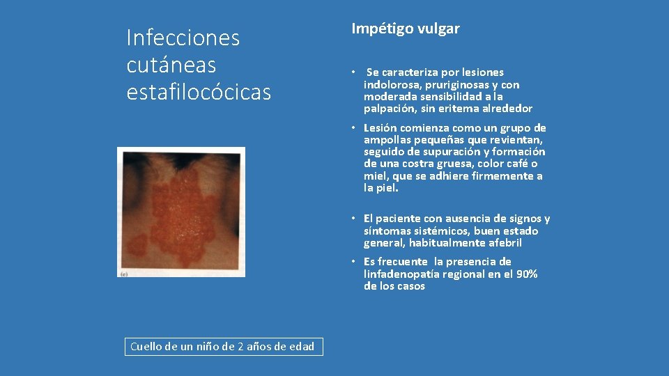 Infecciones cutáneas estafilocócicas Impétigo vulgar • Se caracteriza por lesiones indolorosa, pruriginosas y con