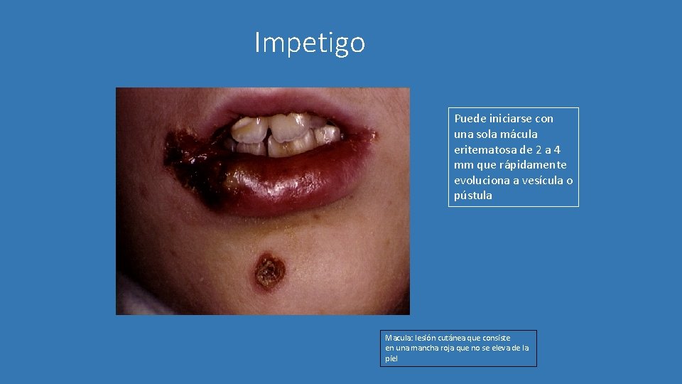 Impetigo Puede iniciarse con una sola mácula eritematosa de 2 a 4 mm que