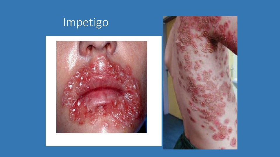 Impetigo 