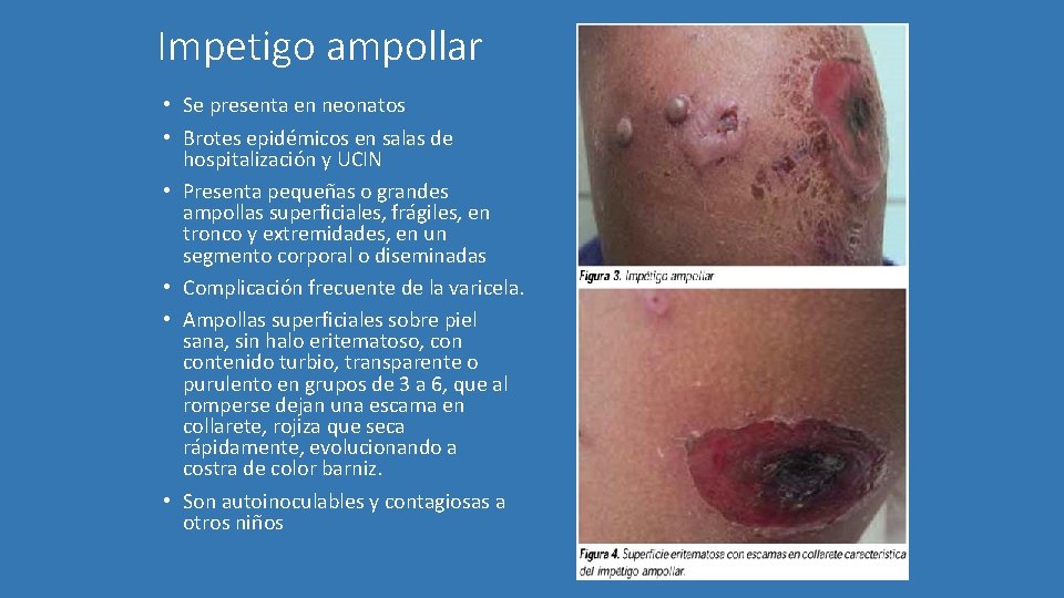 Impetigo ampollar • Se presenta en neonatos • Brotes epidémicos en salas de hospitalización