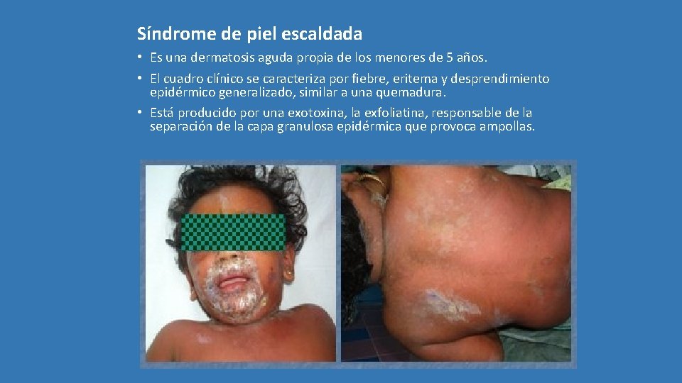 Síndrome de piel escaldada • Es una dermatosis aguda propia de los menores de