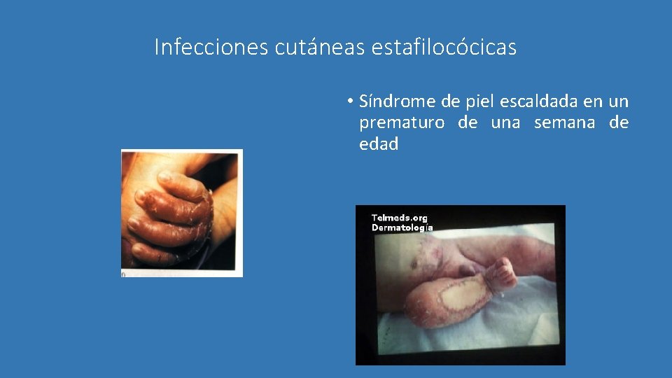Infecciones cutáneas estafilocócicas • Síndrome de piel escaldada en un prematuro de una semana