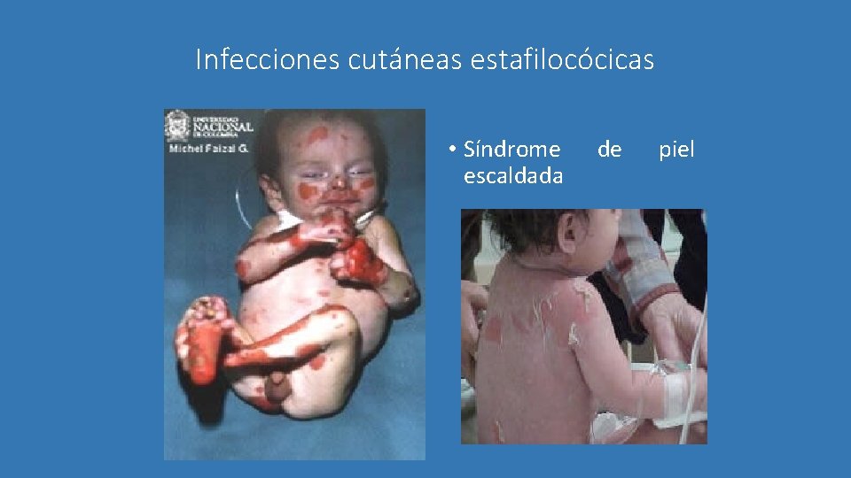 Infecciones cutáneas estafilocócicas • Síndrome escaldada de piel 