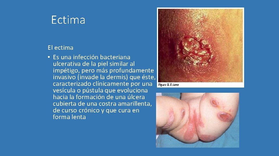 Ectima El ectima • Es una infección bacteriana ulcerativa de la piel similar al