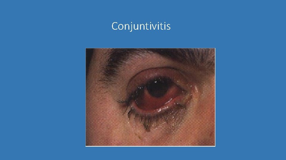 Conjuntivitis 