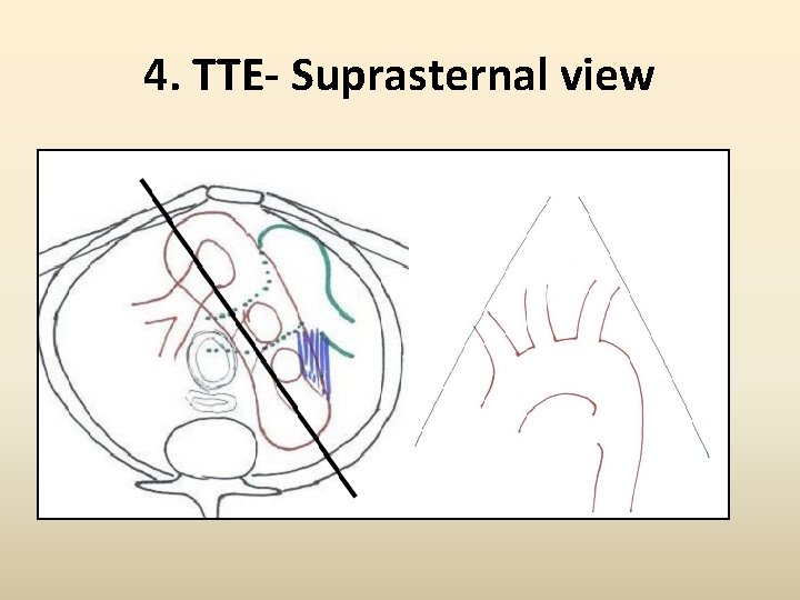 4. TTE- Suprasternal view 