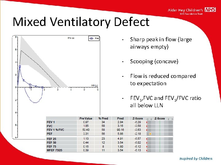 Mixed Ventilatory Defect - Sharp peak in flow (large airways empty) - Scooping (concave) Mixed Ventilatory Defect - Sharp peak in flow (large airways empty) - Scooping (concave)