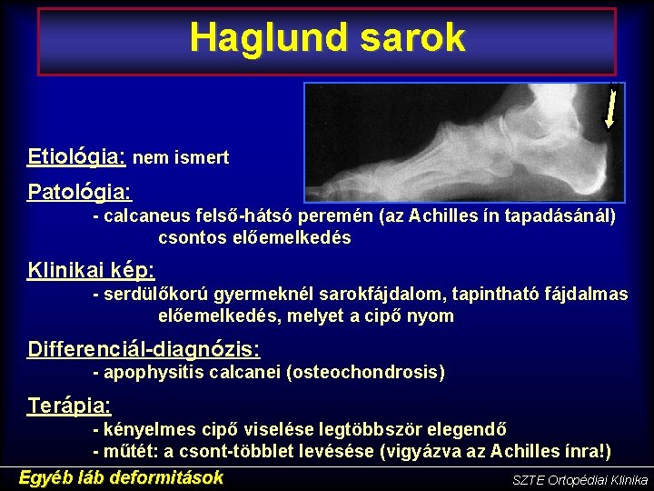 felső osteochondrosis)