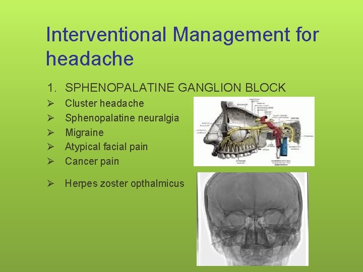 Interventional Management for headache 1. SPHENOPALATINE GANGLION BLOCK Ø Ø Ø Cluster headache Sphenopalatine