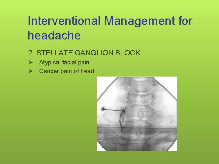 Interventional Management for headache 2. STELLATE GANGLION BLOCK Ø Atypical facial pain Ø Cancer