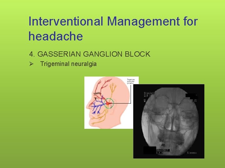 Interventional Management for headache 4. GASSERIAN GANGLION BLOCK Ø Trigeminal neuralgia 126 