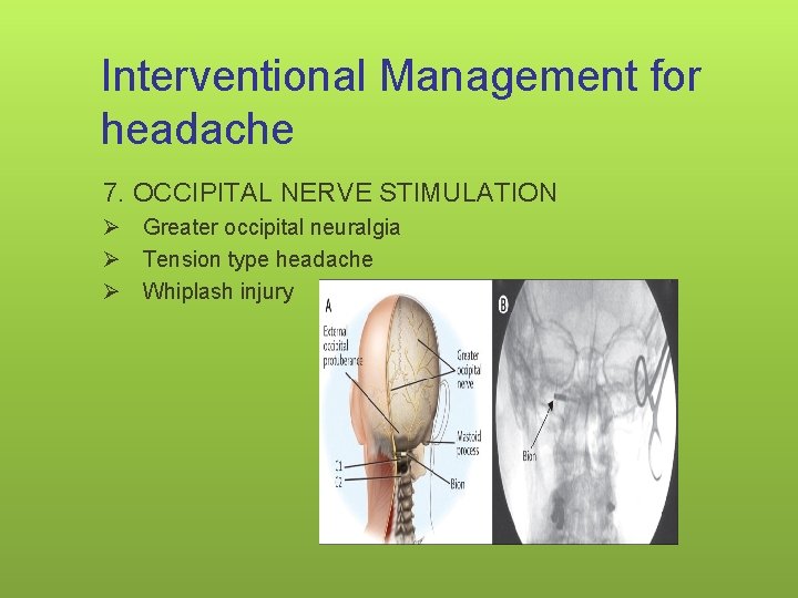 Interventional Management for headache 7. OCCIPITAL NERVE STIMULATION Ø Greater occipital neuralgia Ø Tension