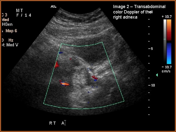 Image 2 – Transabdominal Radiological Presentations color Doppler of the right adnexa 