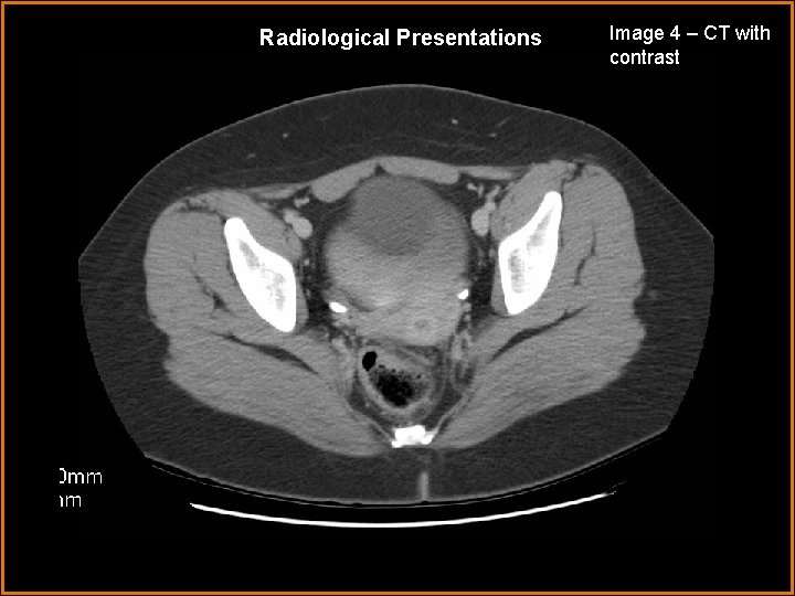 Radiological Presentations Image 4 – CT with contrast 