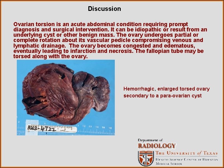 Discussion Ovarian torsion is an acute abdominal condition requiring prompt diagnosis and surgical intervention.