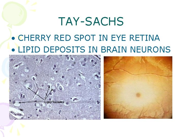 TAY-SACHS • CHERRY RED SPOT IN EYE RETINA • LIPID DEPOSITS IN BRAIN NEURONS