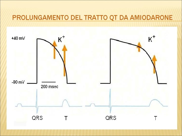 PROLUNGAMENTO DEL TRATTO QT DA AMIODARONE 