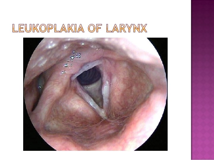 Laryngeal papillomatosis triad. Laryngeal papillomatosis triad