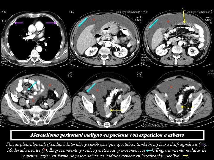 * * * Mesotelioma peritoneal maligno en paciente con exposición a asbesto Placas pleurales * * * Mesotelioma peritoneal maligno en paciente con exposición a asbesto Placas pleurales