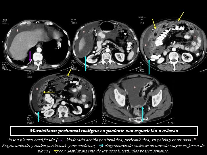 * * * Mesotelioma peritoneal maligno en paciente con exposición a asbesto Placa pleural * * * Mesotelioma peritoneal maligno en paciente con exposición a asbesto Placa pleural
