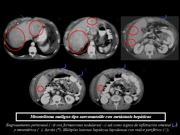 → → → * ^ ^ → ^ ^ ^ Mesotelioma maligno tipo sarcomatoide → → → * ^ ^ → ^ ^ ^ Mesotelioma maligno tipo sarcomatoide