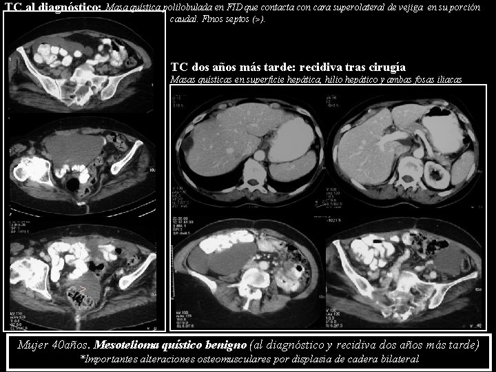 TC al diagnóstico: Masa quística polilobulada en FID que contacta con cara superolateral de TC al diagnóstico: Masa quística polilobulada en FID que contacta con cara superolateral de