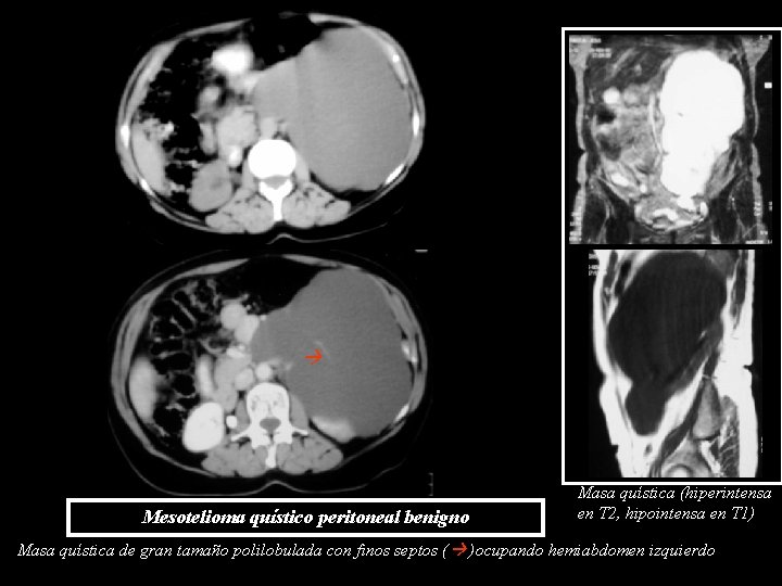Mesotelioma quístico peritoneal benigno Masa quística (hiperintensa en T 2, hipointensa en T Mesotelioma quístico peritoneal benigno Masa quística (hiperintensa en T 2, hipointensa en T