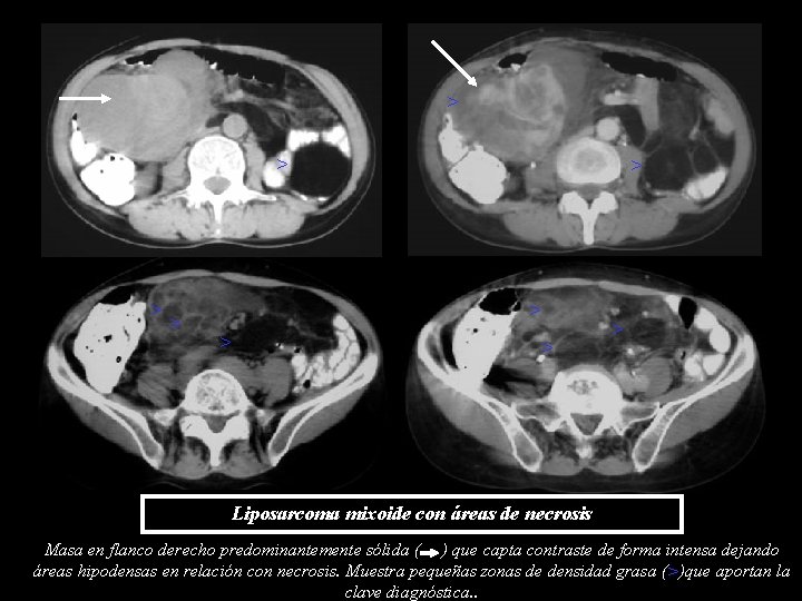 > > > > > Liposarcoma mixoide con áreas de necrosis Masa en flanco > > > > > Liposarcoma mixoide con áreas de necrosis Masa en flanco