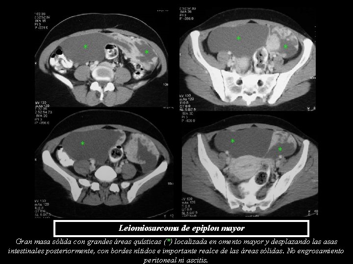 * * * * Leiomiosarcoma de epiplon mayor Gran masa sólida con grandes áreas * * * * Leiomiosarcoma de epiplon mayor Gran masa sólida con grandes áreas