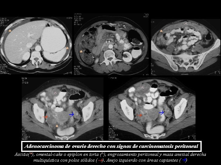 ^ * * * ^ ^ * * Adenocarcinoma de ovario derecho con signos ^ * * * ^ ^ * * Adenocarcinoma de ovario derecho con signos