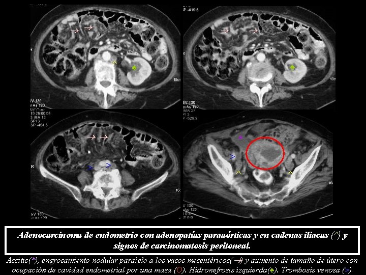 ^ ♠ ♠ > > * > ^ ^ Adenocarcinoma de endometrio con ^ ♠ ♠ > > * > ^ ^ Adenocarcinoma de endometrio con