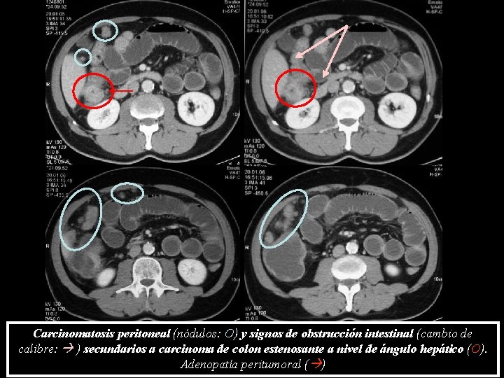 Carcinomatosis peritoneal (nódulos: O) y signos de obstrucción intestinal (cambio de calibre: ) secundarios Carcinomatosis peritoneal (nódulos: O) y signos de obstrucción intestinal (cambio de calibre: ) secundarios